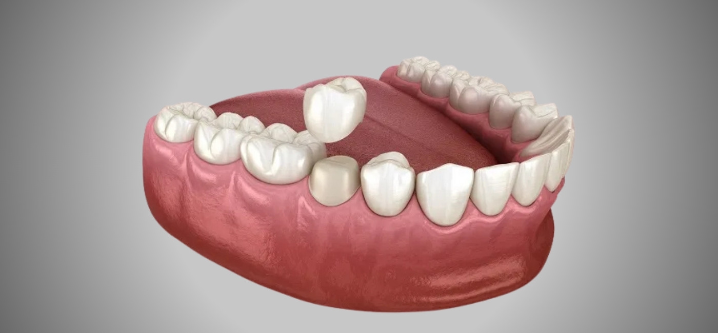 Crown Placement